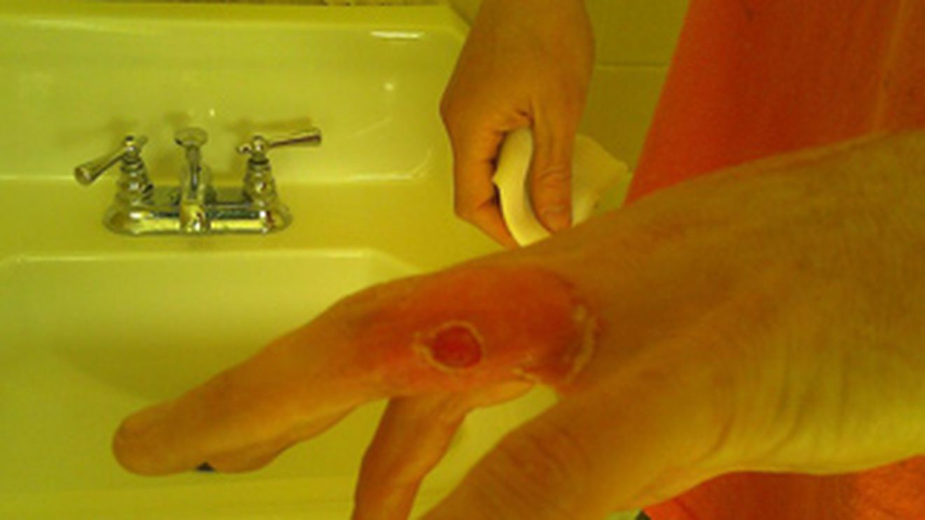 O sa ti se faca sila pentru ca nu ai vazut ceva mai dezgustator! Vezi ce ti se poate intampla si tie daca iti tratezi negii singur!