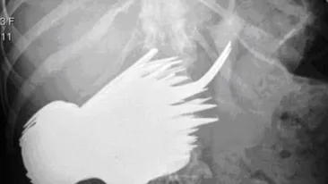 Nu a mai rezistat de dureri si s-a dus la spital! Medicii i-au facut radiografii si s-au crucit cand au vazut ASTA! E un caz unic in lume