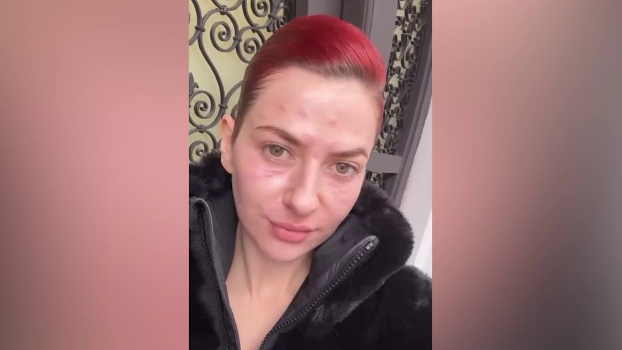 Lidia Buble și-a speriat fanii! A apărut cu fața inflamată și amorțită: „Nu arată rău. Acum e cel mai umflat”