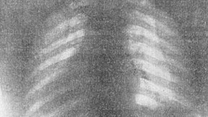 Ce au descoperit doctorii in corpul unei femei. Radiografia care a socat toata lumea medicala
