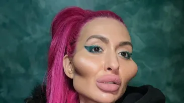 Cum a ajuns să arate o femeie dependentă de botox! Doctorii i-au spus să se oprească