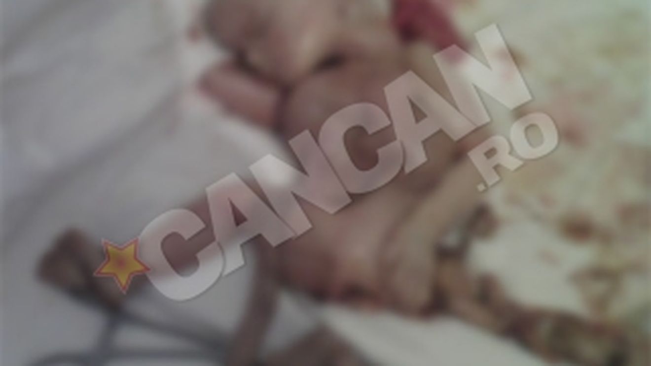 IMAGINI SOCANTE Caz foarte rar in lume! O femeie isi purta fatul mort de doua luni, in abdomen