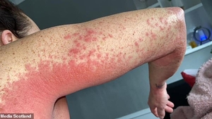 O femeie în vârstă de 41 de ani, reacție ciudată după imunizarea cu AstraZeneca