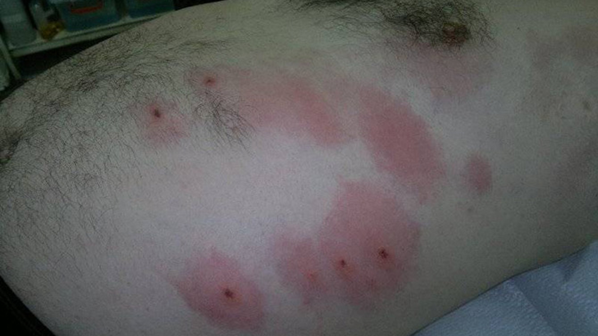 INVAZIA CAPUSELOR! Un iesean a fost muscat de 12 capuse in cateva minute in timp ce se relaxa in iarba