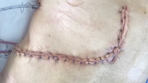 IMAGINI ŞOCANTE! Prin ce a trecut sătmăreanul care a donat o parte din ficat unei necunoscute, fără a-i cere nimic în schimb. Cu ce s-a ales după operaţie