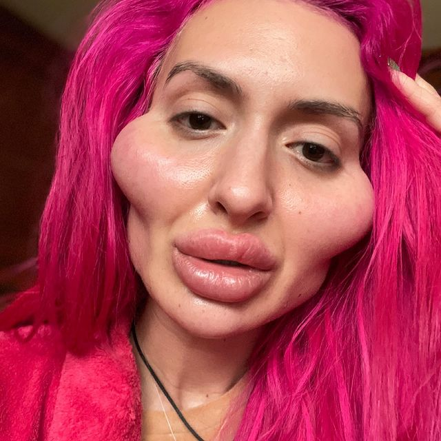 Cum a ajuns să arate o femeie dependentă de botox! Doctorii i-au spus să se oprească
