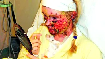 Desfigurata de paracetamol