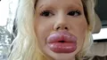 GALERIE FOTO Femeia cu cele mai mari buze din lume a trebuit să-și injecteze și nasul pentru că avea fața asimetrică