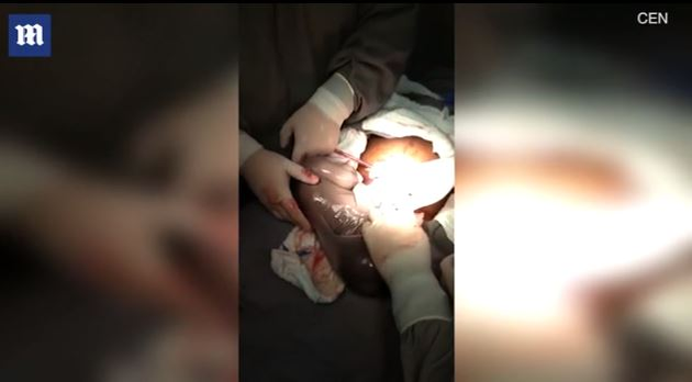 Imagini emoționante în sala de operații: un băiețel s-a născut în timp ce era încă în sacul amniotic. Cazul este foarte rar: 1 la 80.000 de nașteri | FOTO & VIDEO