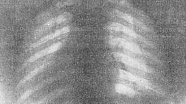 Ce au descoperit doctorii in corpul unei femei. Radiografia care a socat toata lumea medicala