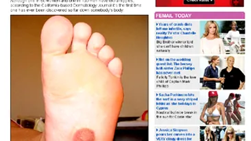 Unei femei de 22 de ani i-a crescut un sfarc in talpa