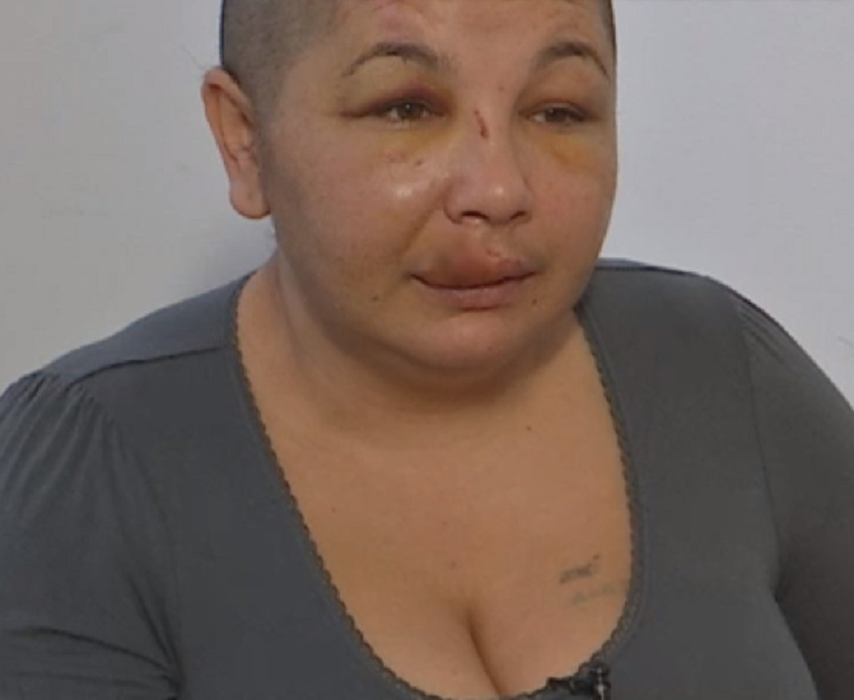 O femeie, ruptă în bătaie şi tunsă la chelie de soţul agresiv: ”A venit cu o husă neagră… Carnea mea e bătută…”