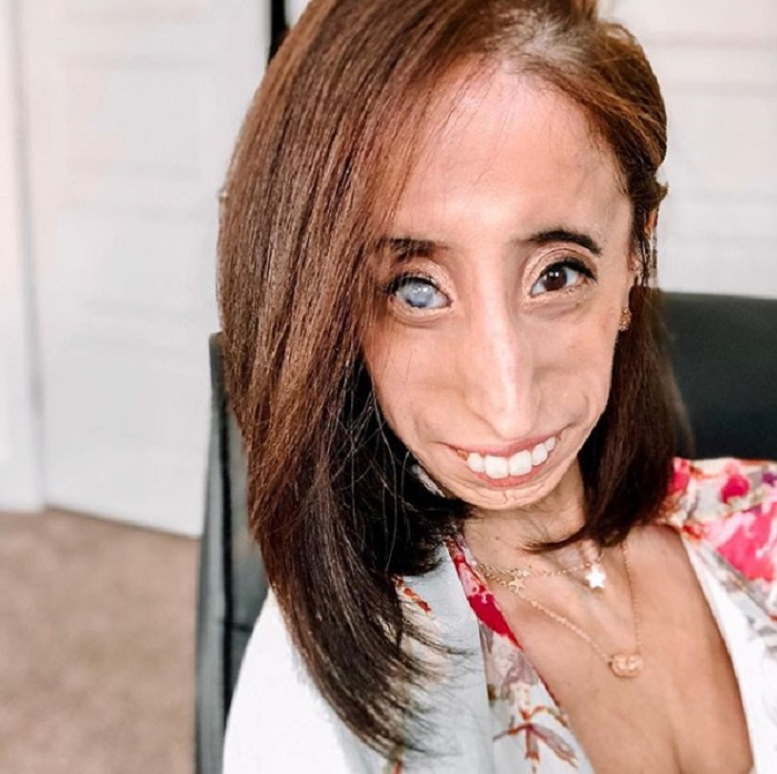 A fost catalogată “cea mai urâtă femeie din lume”, iar acum… Cum arată, în prezent, Lizzie Velasquez
