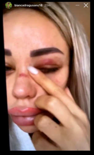 Bianca Drăgușanu desfigurată de Alex Bodi