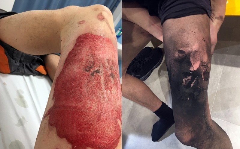 Ştiai că ţi se poate întâmpla asta? Acest tânăr a suferit un accident horror, după ce ţigara electronică i-a explodat în buzunar | FOTO