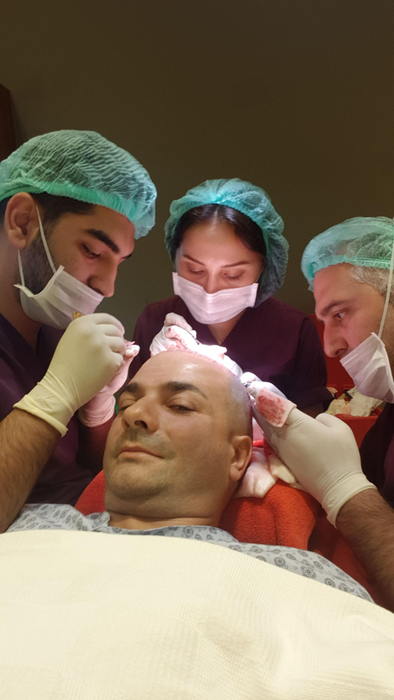 Ești interesat de procedura de implant de păr? Consilierul medical Ensar Duman îți spune ce tehnici noi se realizează în Turcia