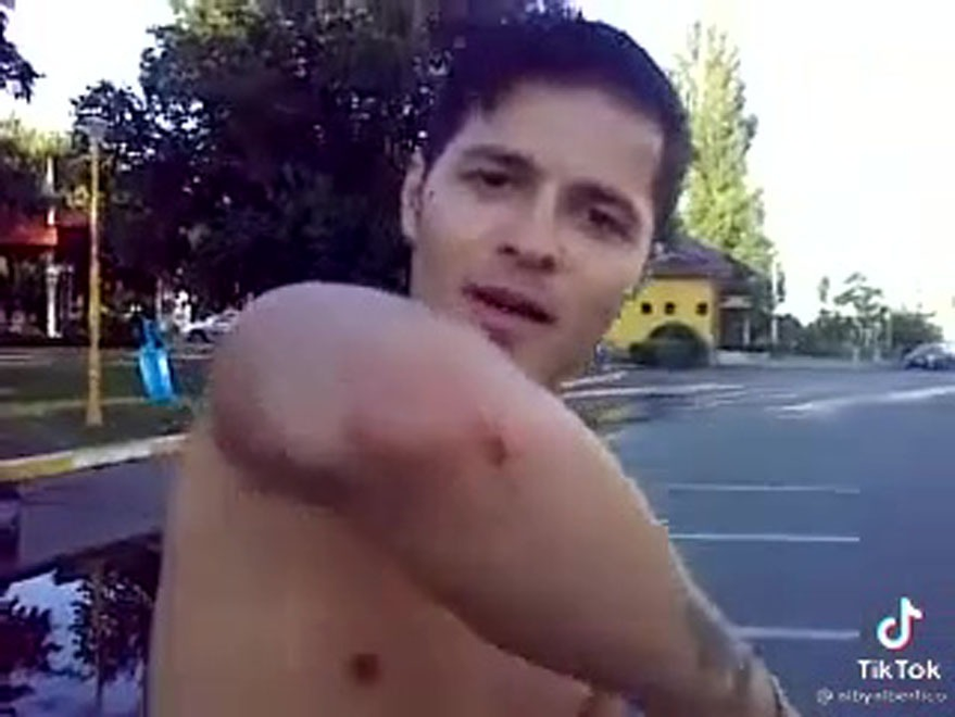 Liviu Vârciu își arată rănile / Sursă foto: captură video