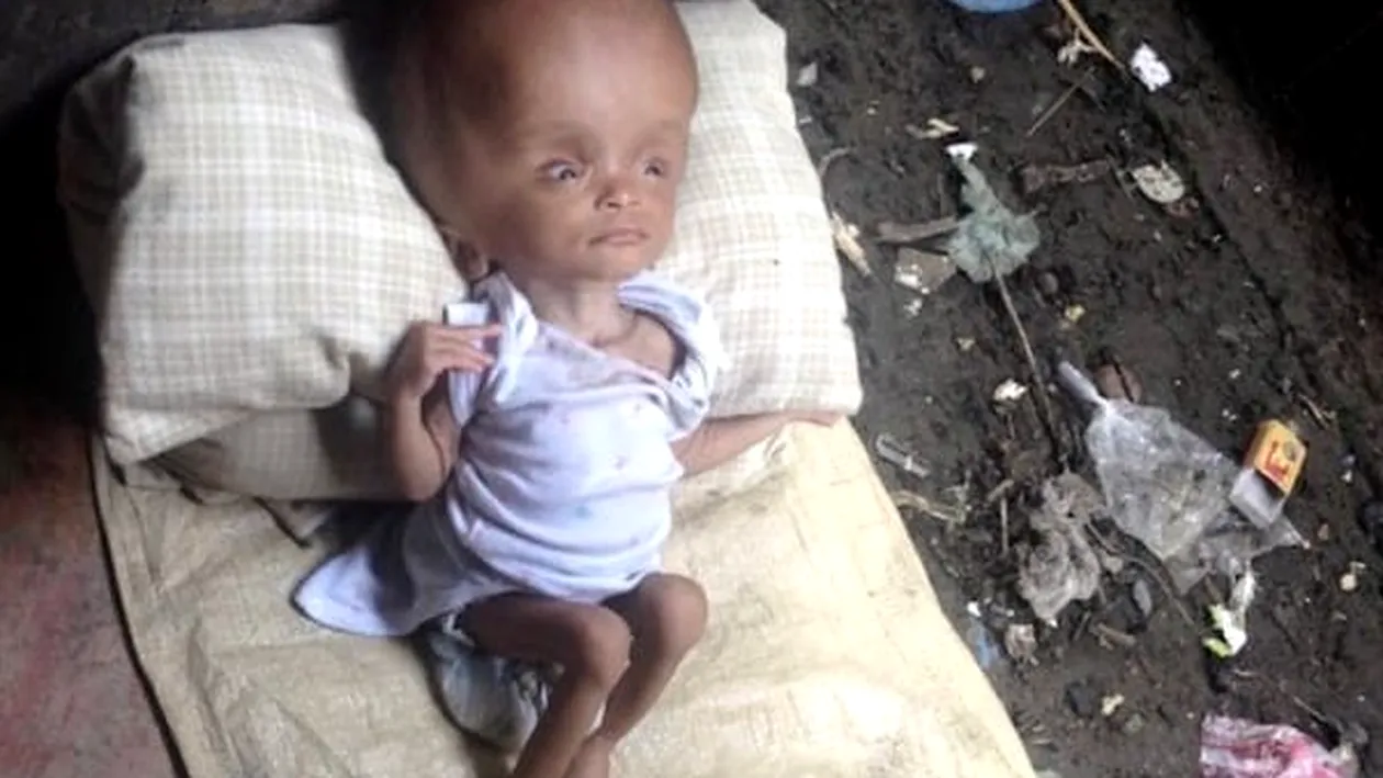 O femeie a găsit o fetiţă care suferă de o boală îngrozitoare. Medicii nu i-au dat speranţe de viaţă, dar şi-a revenit miraculos. Cum arată acum micuţa 
