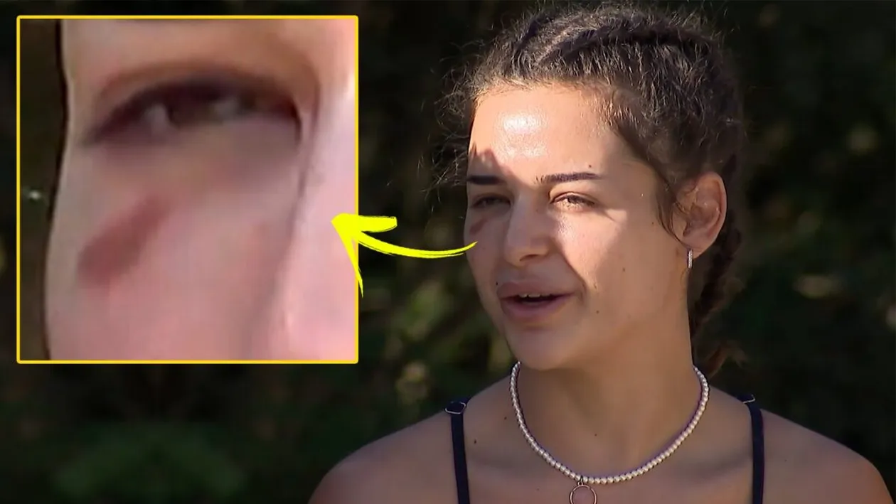 Oana Ciocan, cu o lovitură suspectă la Survivor All Stars. Ce a pățit iubita lui Jador, de fapt