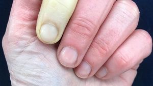 O vedetă a ținut boala ascunsă, însă acum a spus adevărul: "Aceasta e mâna mea". Cât de gravă e maladia cu care a fost diagnosticată
