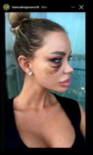 Imagini șocante cu Bianca Drăgușanu desfigurată de Alex Bodi