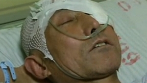 A avut un accident casnic si s-a dus de urgenta la spital! Ce au gasit medicii in craniul lui: "Nu am simtit cand a intrat"