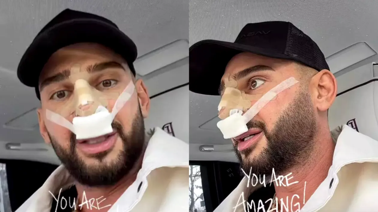 Cum arată nasul lui Dorian Popa, la 12 zile de la intervenție. Artistul a publicat prima imagine