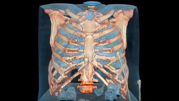 VIDEO. Cum arată plămânii unui bărbat infectat cu coronavirus. Pancientul era asimptomatic, dar...