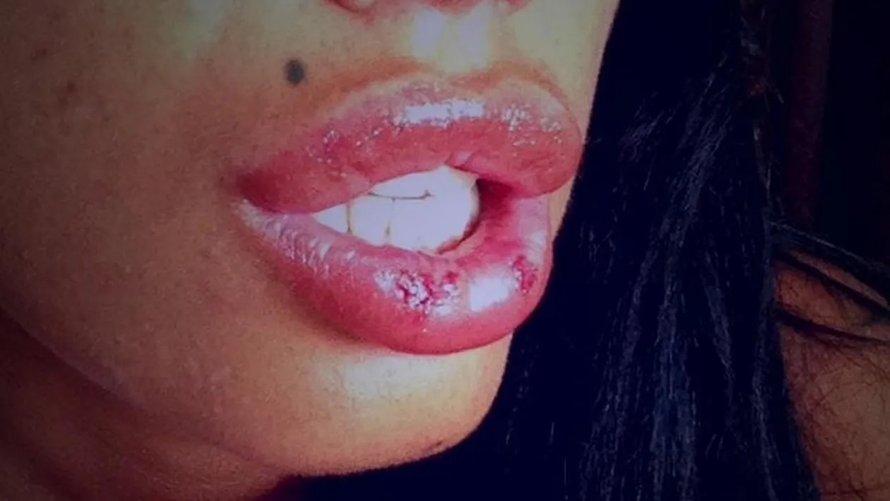 Iti vei aminti multa vreme de pozele astea! I-au “explodat” buzele femeii care s-a indragostit de Bianca si acum arata asa!