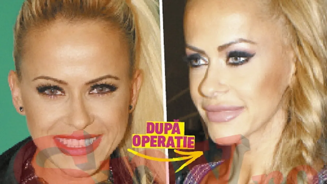 Buzele tale, operate-n graba mare Anda Adam, cap de lista in topul operatiilor estetice terminate prost!