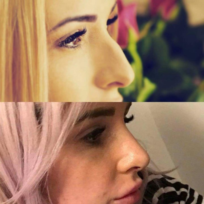 Diferența dintre nasul ei și cel operat