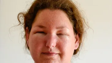 Cum arată această femeie după ce s-a dat cu o lotiune impotriva arsurilor! S-a privit in oglindă si nu s-a mai recunoscut