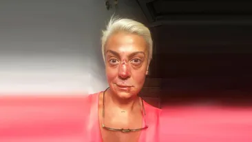 Monica Anghel, desfigurată! NU e machiaj şi nici Photoshop: a povestit ce i s-a întâmplat