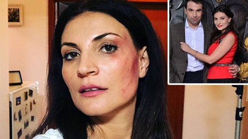 "Mi-am luat-o" Ioana Ginghină, cu fața tumefiată la doar câteva zile după ce s-a spus că divorțează de Alexandru Papadopol