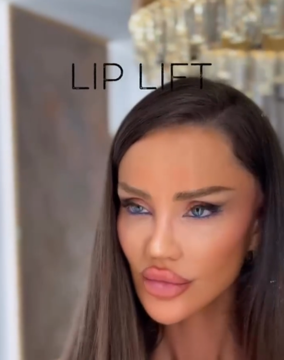 Cum arată Bianca Drăgușanu după intervenția de lip lift. A trecut aproape o lună de când și-a modificat buzele