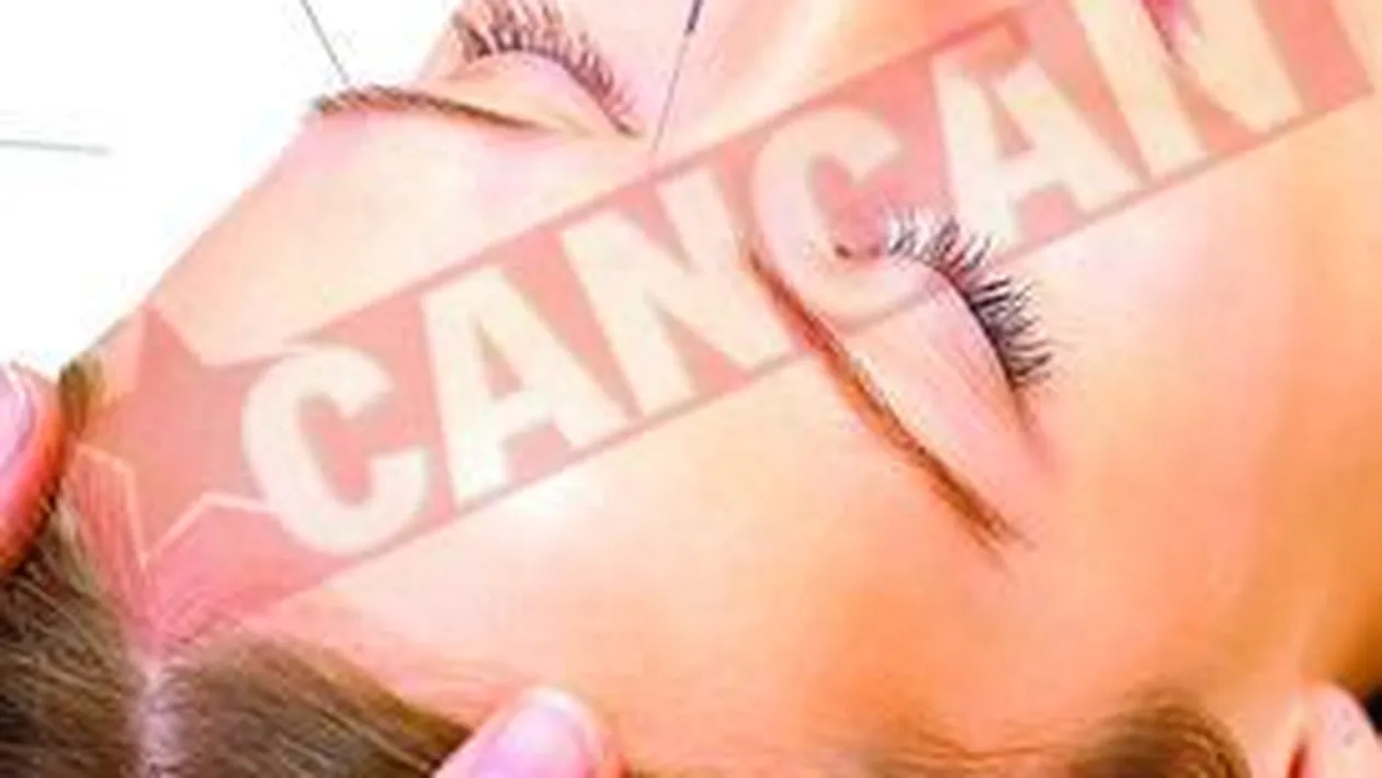 Cand va doare capul faceti acupunctura!