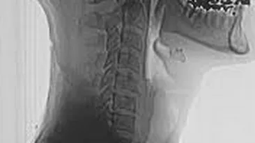 Ce au gasit medicii germani in gatul unui tanar din Afganistan. Avrea 10 centimetri si se afla in trupul barbatului din copilarie