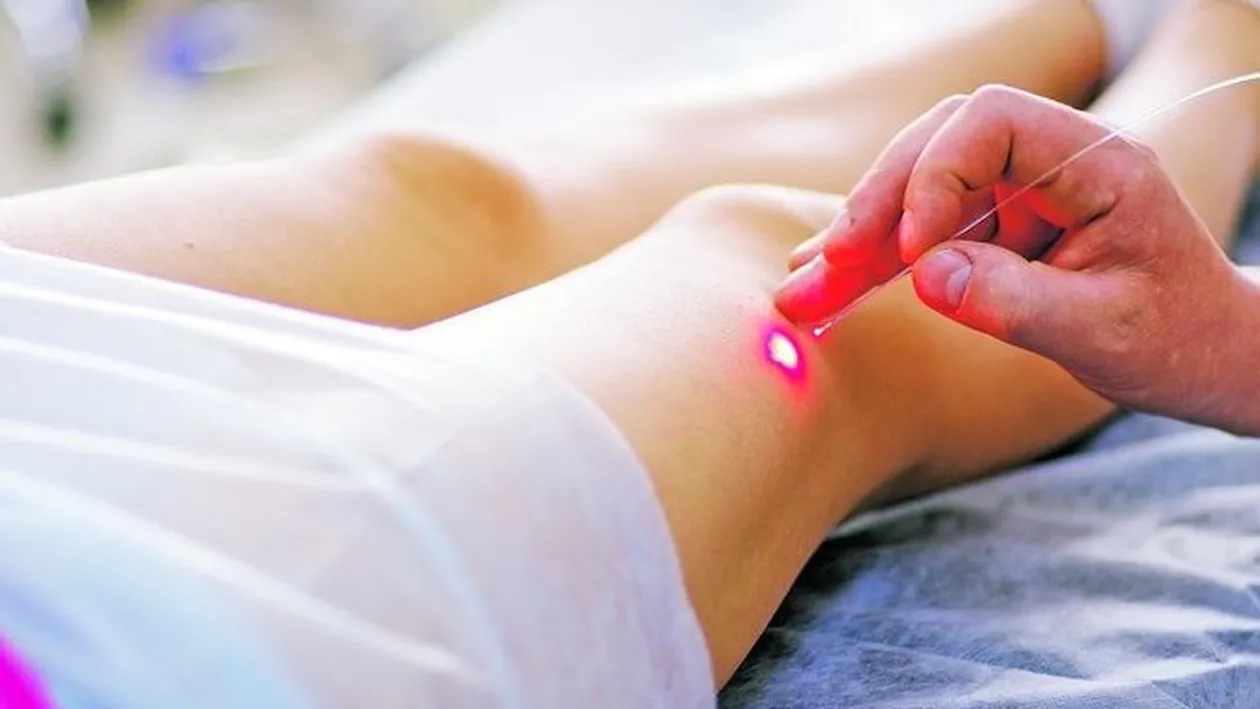 Care sunt cele mai noi remedii pentru tratarea aspectului inestetic al venelor! Cum sa scapam de vinisoare