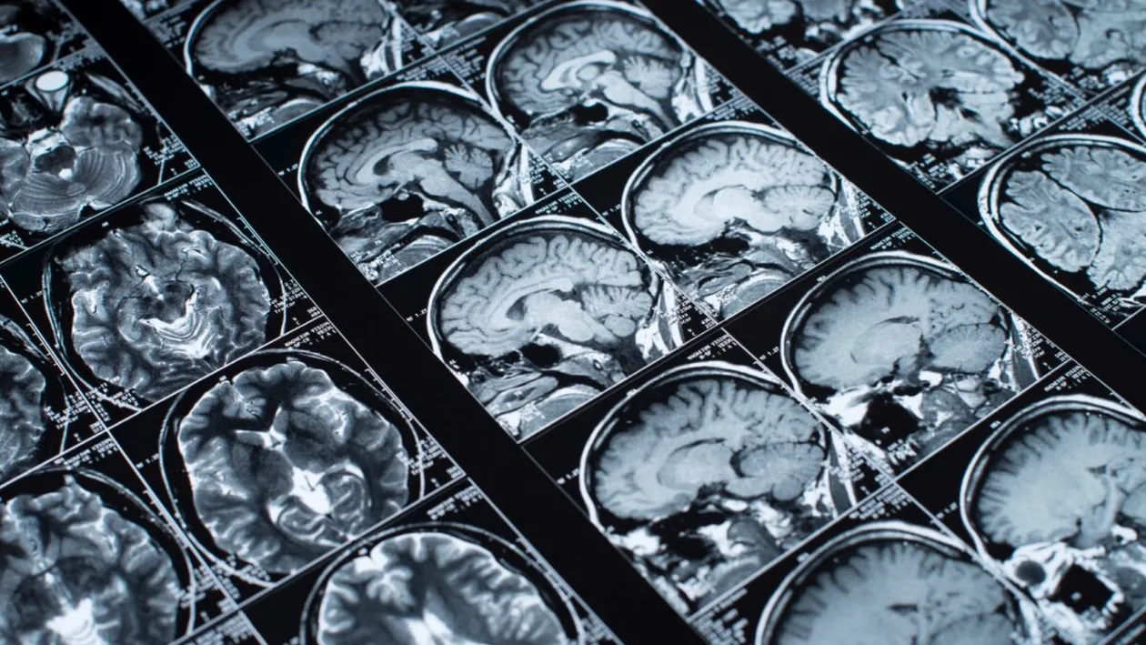 Gestul aparent inofensiv care îți poate dubla riscul de AVC. Majoritatea românilor îl fac fără să știe