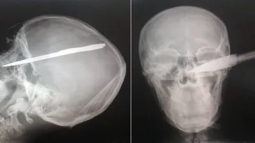 Radiografie socanta! Un tanar a ajuns la spital cu o sabie infipta in cap! A avut un noroc chior si acum e sanatos!