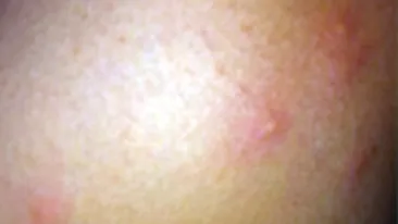 Doinita Oancea nu mai poate dormi: Am in jur de 50 de muscaturi pe maini si picioare care s-au umflat