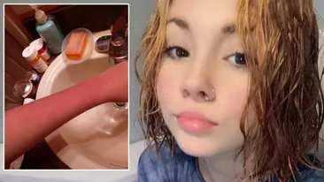 Ce este urticaria acvagenă - boala rarisimă cu care a fost diagnosticată această tânără. Este alergică la apă și la propriile-i lacrimi