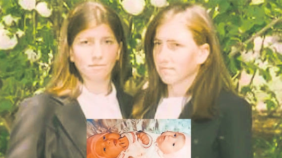 Legatura paranormala intre siamezele romance care au facut istorie in medicina mondiala! Ce s-a intamplat cu Lina!