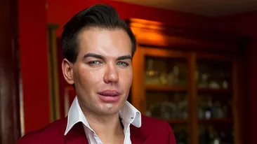 „Păpuşa umană“ KEN şi-a făcut o nouă operaţie estetică şi a mărturisit: „Bucăţi mari de piele au început să mi se desprindă de pe faţă“