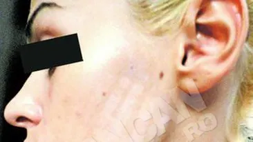 O tanara din Capitala a fost arsa la salonul de infrumusetare