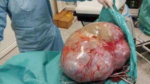 FOTO. Caz incredibil la Botoșani. Tumoare de 24 de kilograme, extirpată din abdomenul unei femei infectată cu COVID-19