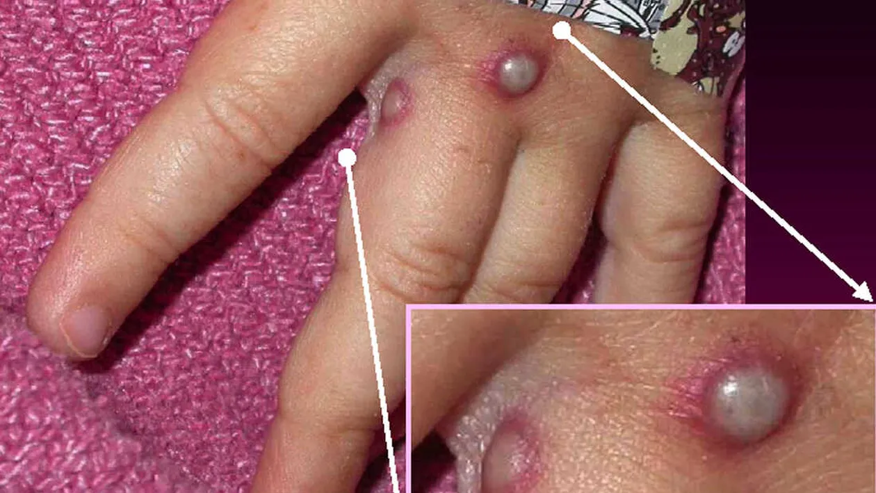 Variola maimuței se extinde în România! Al treilea caz a fost deja confirmat