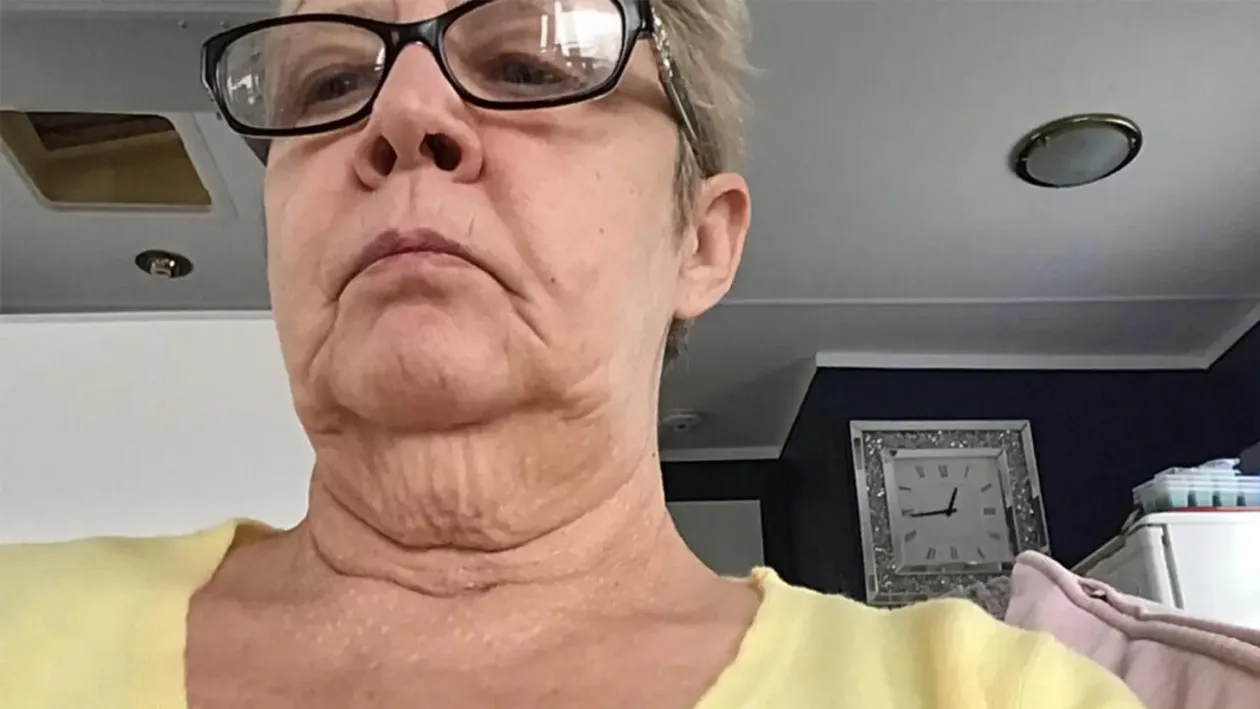 Femeia din imagine a făcut o operație chirurgicală, pentru a scăpa de gușa inestetică, dar regretă profund. Ireal cum arată acum