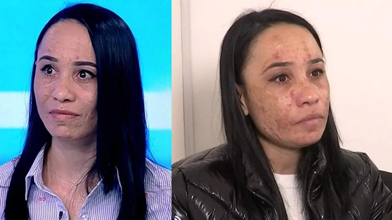 Fața i-a fost distrusă! O tânără a fost desfigurată de un cosmetician. „M-a nenorocit și aș vrea să plătească”
