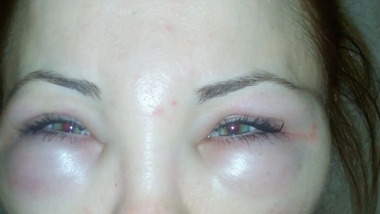 I-a paralizat fata! O avocata de la noi este in stare grava dupa ce a incercat sa scape de riduri